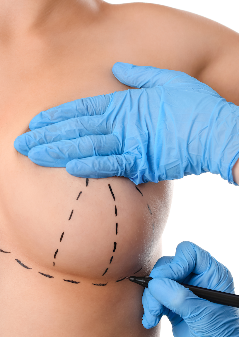11Breast reduction injury lawyer